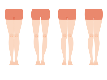 気になるO脚の改善方法